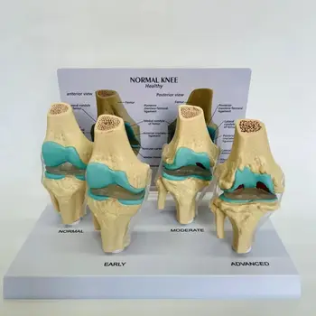 1 шт Анатомия человека, Скелет в натуральную величину, 4-Ступенчатая Анатомическая модель коленного сустава, учебные принадлежности